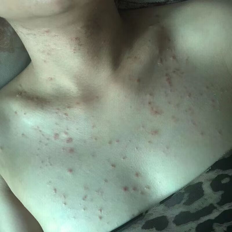 芙永健皮肤瘙痒止痒喷雾身上长痘痘痒全身止痒喷剂身上痒全身止痒 1