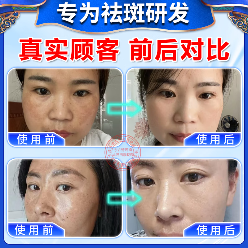 [臣功]维A酸乳膏 祛斑霜黑色素祛斑专用药黄褐斑日晒斑雀斑老年斑强力祛除手脸部消除男女专【视觉特效】 15克/支 1盒装 【标准装】