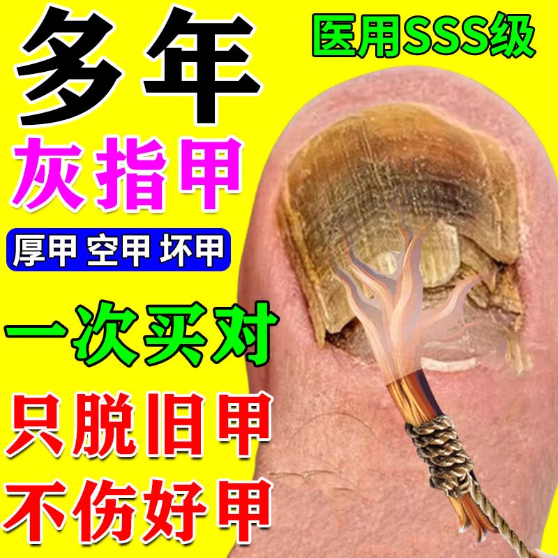 灰指甲专用药治甲癣指甲真菌感染脱甲坏甲空甲凹凸有坑甲片增厚发黄