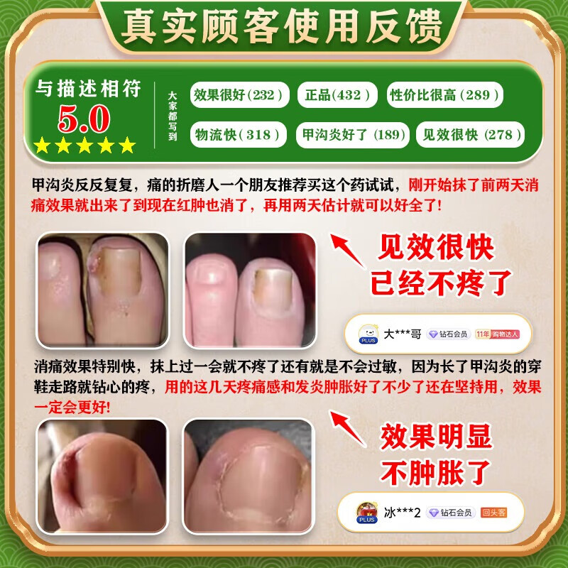 [华青]克霉唑乳膏 10g 1盒装 甲沟炎专用去药根部治脚趾甲往肉里长消肿止痛去肉芽治严重息肉外用消炎药【视觉特效】 +1盒溶液 消肿止痛 无需拔甲