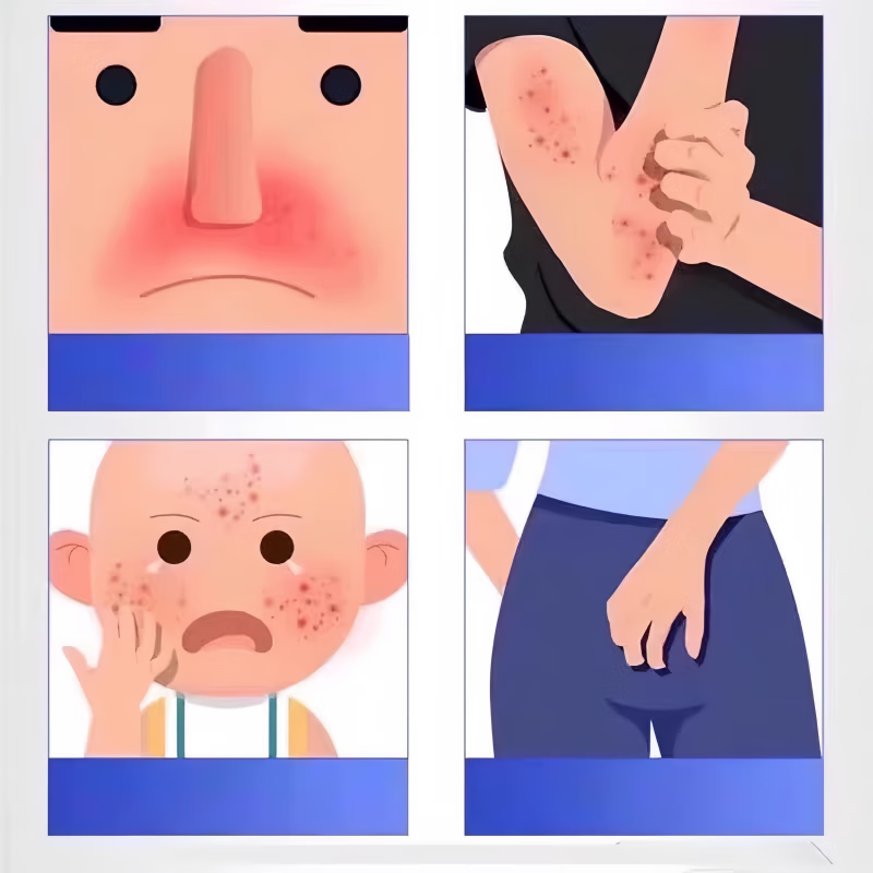 祥醫堂吡美司莫乳膏阴囊湿疹神经性皮炎湿疹藓痒皮肤瘙痒湿痒抑菌止痒  5支-吡美抑菌乳膏正品