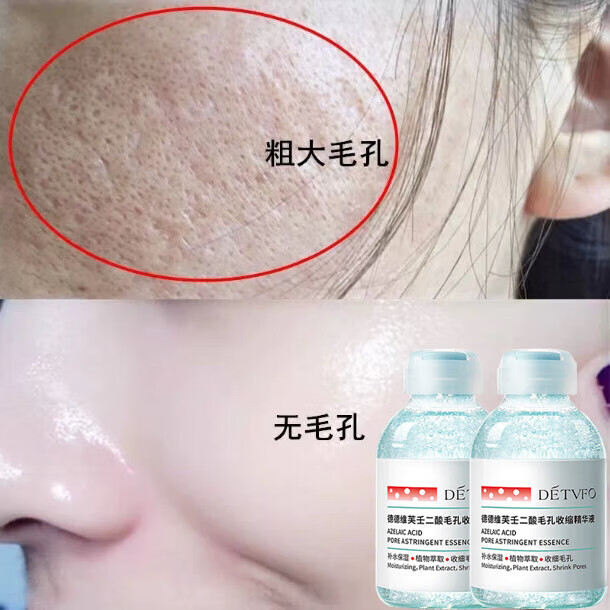 德德維芙（DETVFO）（DETVFO）20%壬二酸美白精華別擠讓我吸排出臟東西去面部毛孔垃 三瓶買(mǎi)二送一