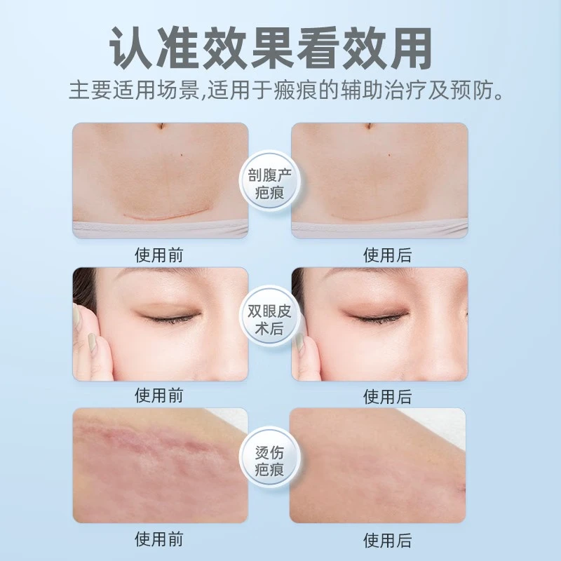 维德（WELLDAY）医用祛疤膏疤痕贴祛疤克星疤痕平儿童专用手术摔烧烫伤面部增生 【甲状腺适用】5*7.5cm*2片/盒