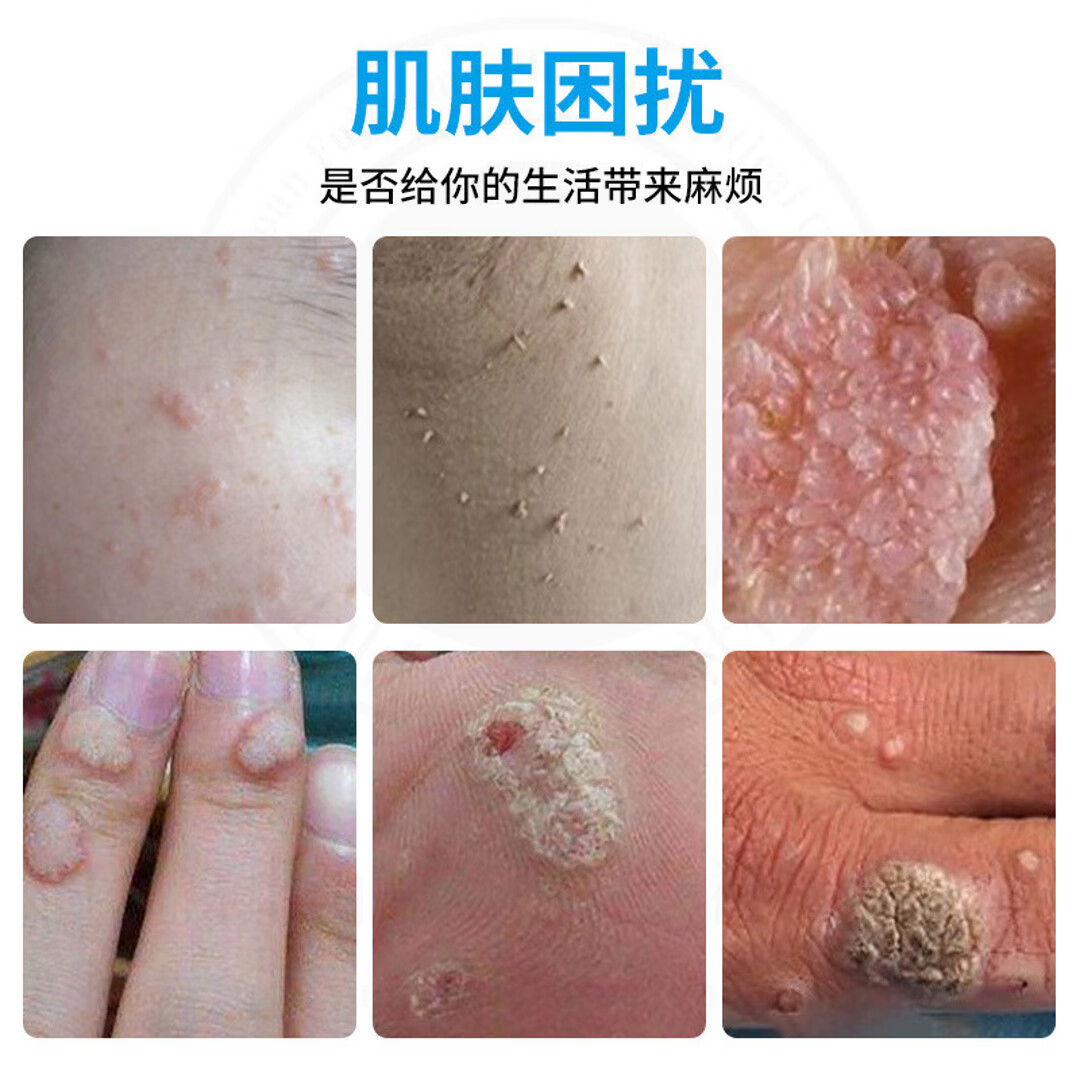 示博士疣瘊清喷雾剂脖子上长猴子肉粒疙瘩寻常疣丝状疣肉刺去除神器 一瓶【体验装】
