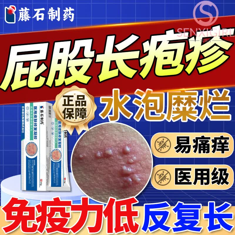 臀部单纯带状疱疹引起屁股反复红水泡溃烂疼痛搭大师贴药房同售 1盒