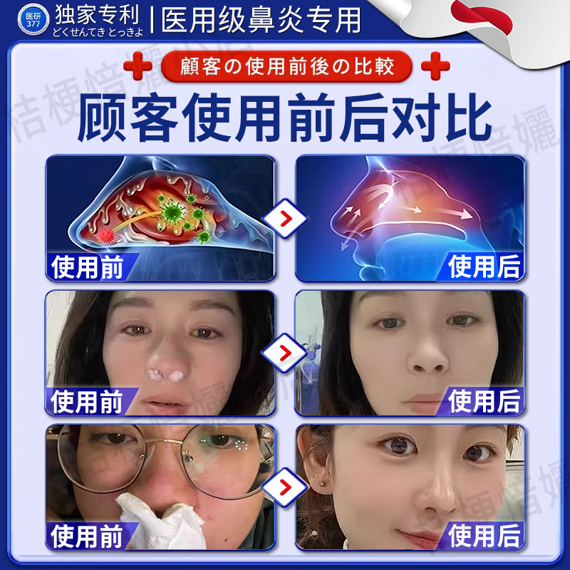坂枝野寻鼻炎日本原装进口苍耳子鼻炎鼻贴过敏性鼻窦炎苍耳子穴位贴专用膏 【过敏性鼻炎常备】买五送四 鼻贴过敏性鼻炎贴远红外鼻塞通鼻
