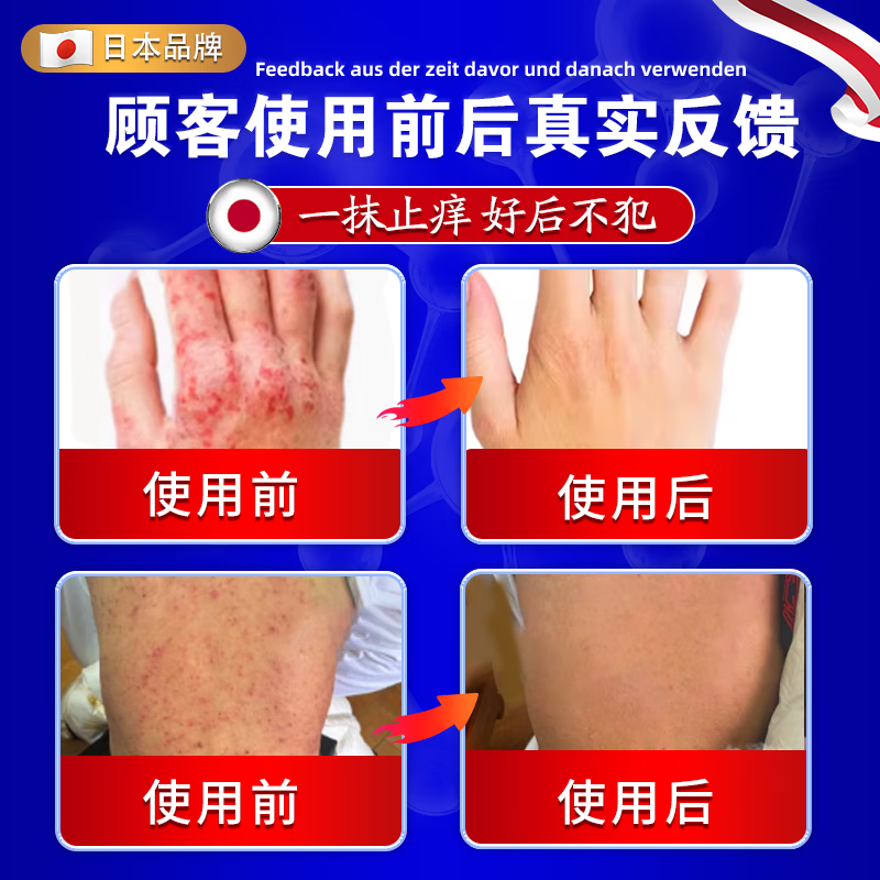 北京协和医学院日本进口湿疹药膏湿毒清皮肤瘙痒皮炎100%真菌王感染去止痒根专用 特效1盒【日本原装进口】柏可芬软膏 苗药顽固湿疹热疹皮癣婴儿抑菌止痒膏湿疹药膏十大牌子