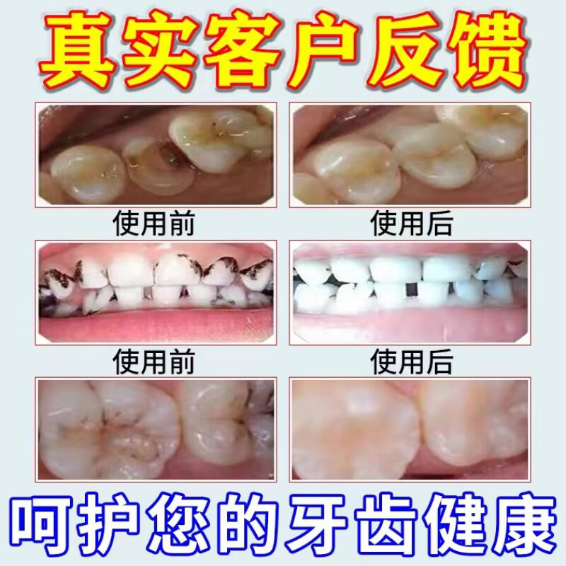 含氟牙膏龋齿牙白脱矿黑窟窿牙黑斑修复清洁去烟渍牙防蛀牙膏 90g/1盒