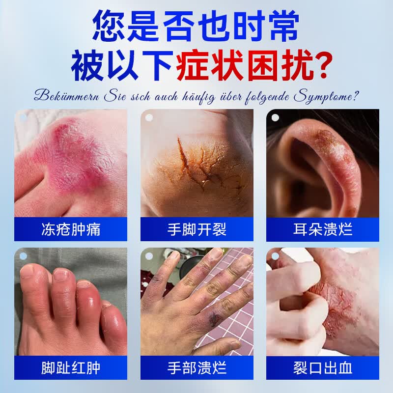 VADERNVA德国冻疮膏耳朵手足成人脸止痒冻伤膏消痛儿童男女士冻伤膏特效 三盒装【中重度】冻疮感染红肿出血
