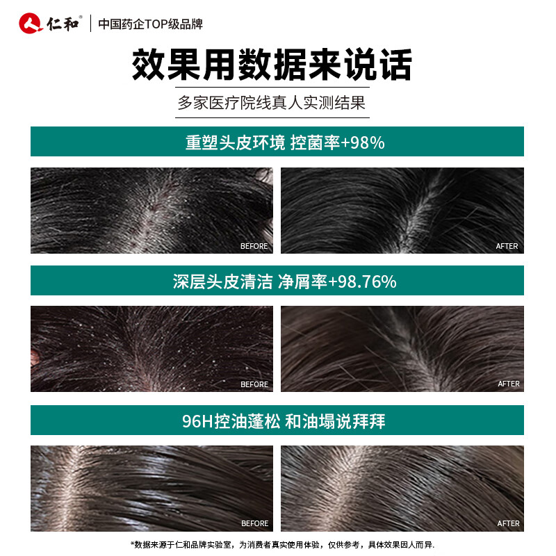 仁和医用重组胶原蛋白头部护理敷料专用脂溢性皮炎瘙痒头皮糠疹头质白 1瓶装/200ml/毛囊炎护理瘙痒头皮屑洗发水状