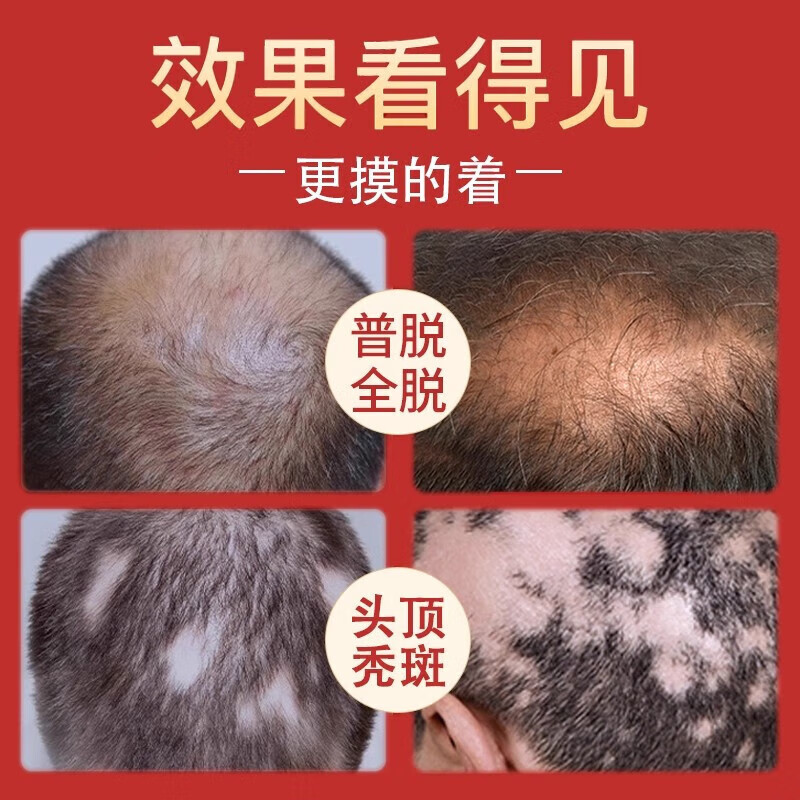 [仁和]固肾生发丸 2.5g*27袋 10盒装 斑秃 全秃 普秃及肝肾虚引起的脱发严重男女专用掉头发的药养血 2.5g*27袋