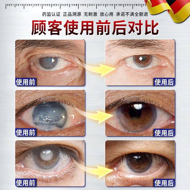 正精研康白内障眼药水老年人专用日本进口治疗中老年人白内障视力模糊术后 眼贴【眼浑浊 看不清】买二送一 中老年人白内障叶黄素滴眼液眼贴