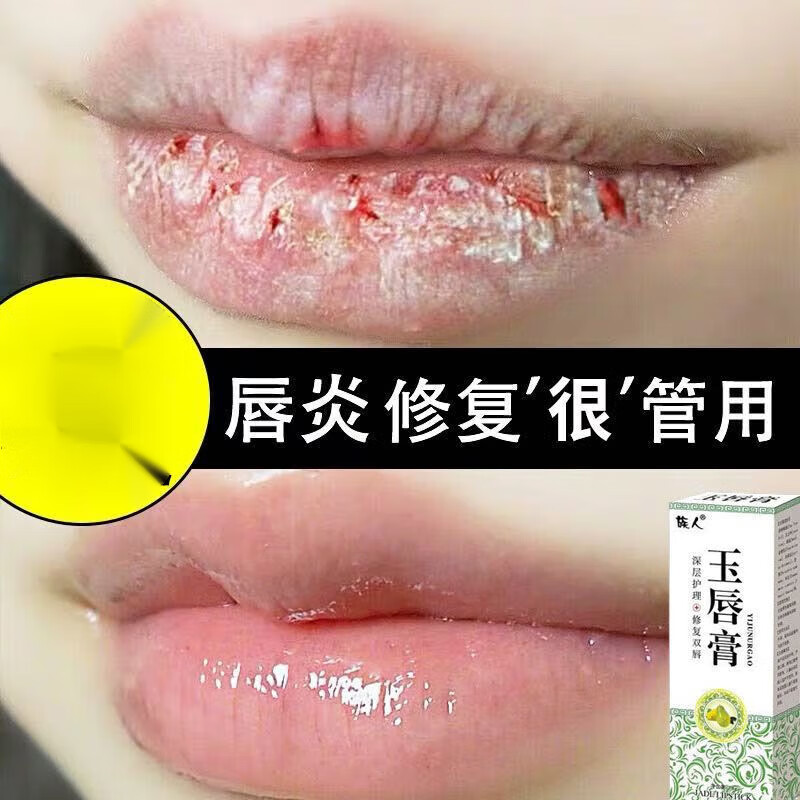 族人唇l炎膏嘴角起泡润唇膏修复嘴唇干裂起皮唇周炎乳膏过敏性唇焱红