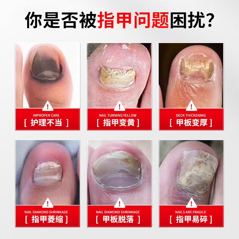 丸気灰指甲膏药指甲真菌感染灰甲净抑菌液医用黄甲灰甲坏甲专用正品 两瓶装