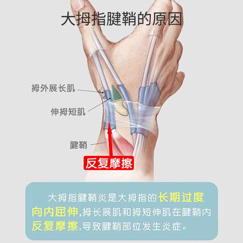 通用手腕拉伤腱鞘炎护腕关节扭伤手腕保护套妈妈鼠标手固定康复矫 肤色 左手【松紧可调透气】 S码