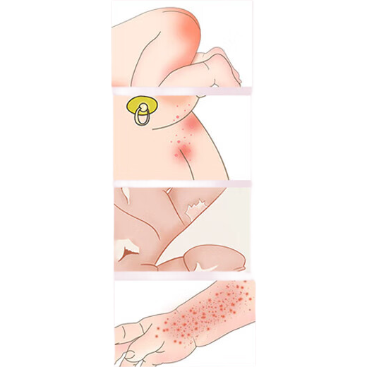 馬應龍氧化鋅軟膏乳膏10g正品治濕疹止癢嬰兒無激素紅屁屁用成人新生兒童皮炎濕疹痱子藥膏祛痱官方旗艦店 3盒【不含激素】官方正品