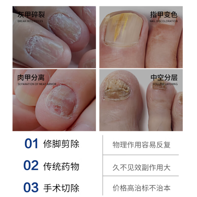 斯诺舟30%浓度冰醋酸溶液抑菌液灰指甲真菌感染专用液高浓度醋酸30ml 特效快速发货【3盒装】性价比