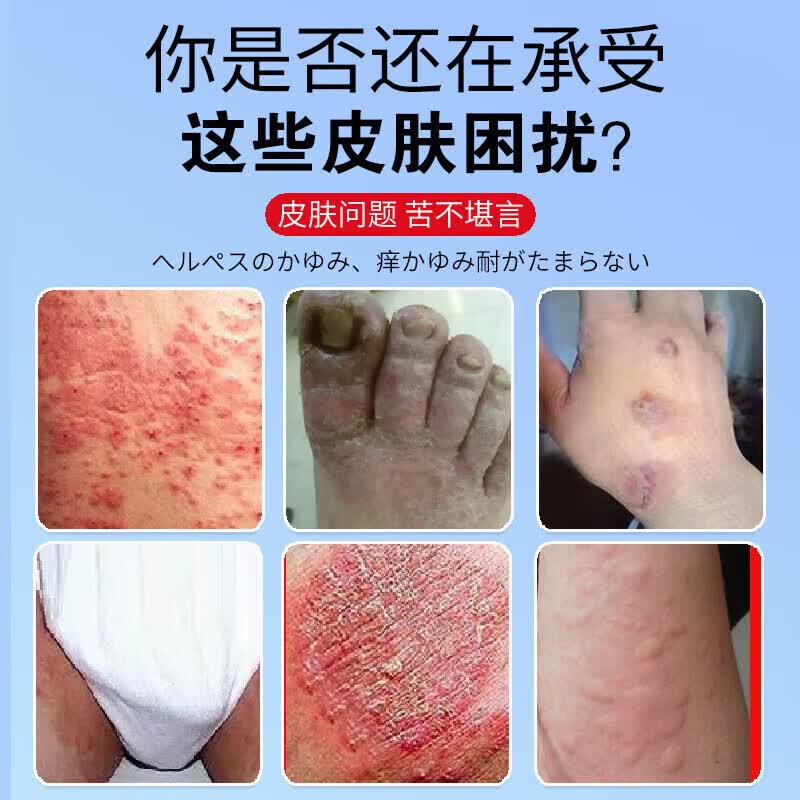 日本化藥【一抹止痒】日本特效炉甘石皮肤干痒抑菌润肤乳全身适用止痒药膏 1瓶体验装【3秒快速止痒】温和配方不过敏 湿i诊外用全身皮肤手脚干痒真菌杀菌