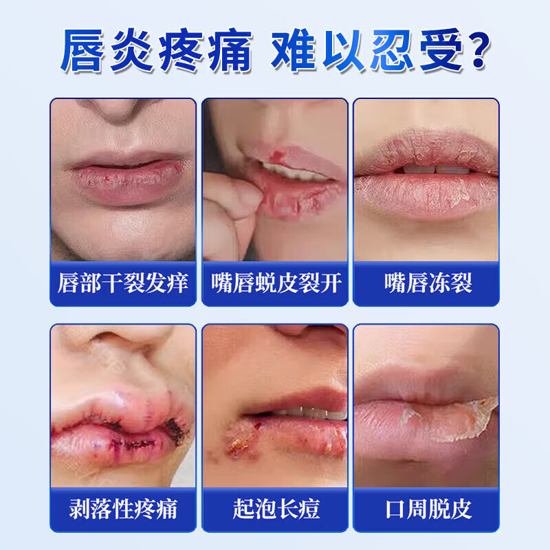 Sunoyar唇炎润唇膏专用医用级唇炎膏慢性嘴唇干裂保湿滋药男女干裂脱皮 10支装【买5送5】摆脱口角炎