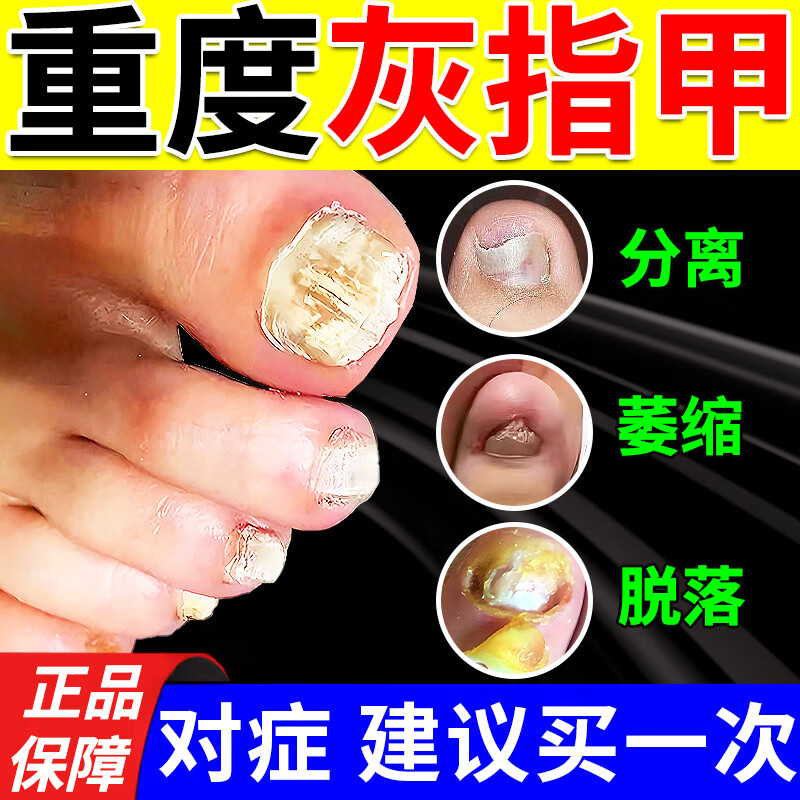 亮甲灰指甲药根药正i治品灰指甲药膏坏指甲真菌感染脱甲去看灰指甲