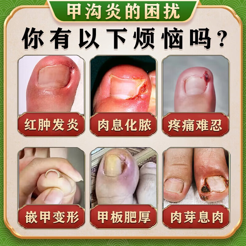 [华青]克霉唑乳膏 10g 1盒装 甲沟炎专用去药根部治脚趾甲往肉里长消肿止痛去肉芽治严重息肉外用消炎药【视觉特效】 +1盒溶液 消肿止痛 无需拔甲