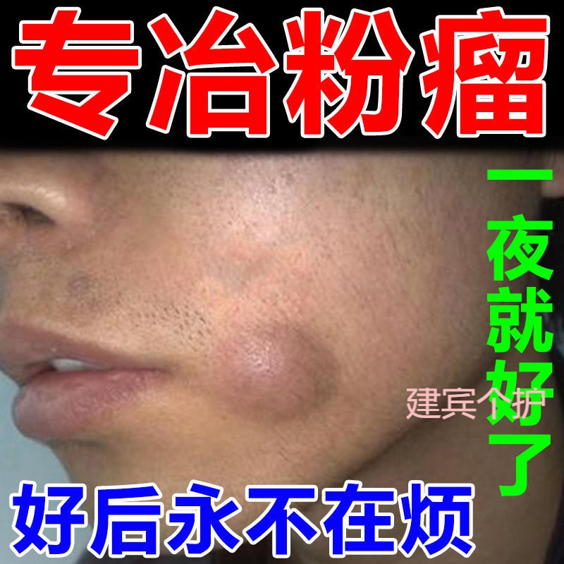 粉瘤皮脂腺囊肿专用膏消顽固性粉瘤去除皮下硬块肿块化脓疼痛大包 单