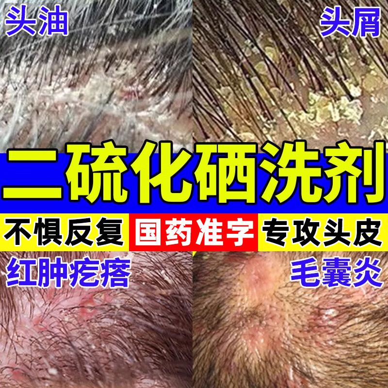 二硫化硒洗剂洗发水去屑止痒控油持久蓬松头痒真菌头皮屑多毛囊炎头部专用药脂溢性皮炎头皮癣 洗发水 1瓶 1瓶装【头屑 头痒 脂溢性皮炎】
