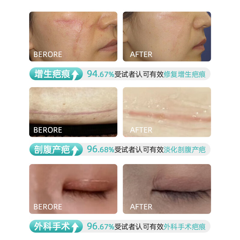 焕研肌-OTC款医用硅酮疤痕凝胶祛疤膏淡化划伤烫伤双眼皮剖腹产手术疤痕 OTC款-20g