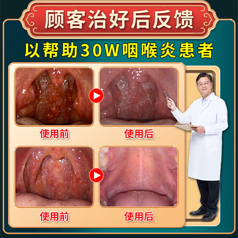 岩井昃弘进口咽喉炎专用膏药贴重度急慢性咽炎喉咙痒干咳呕痒异物感咽扁 特效一盒【日本原装】多买多送 咽喉炎的喉咙痒异物感有粘痰