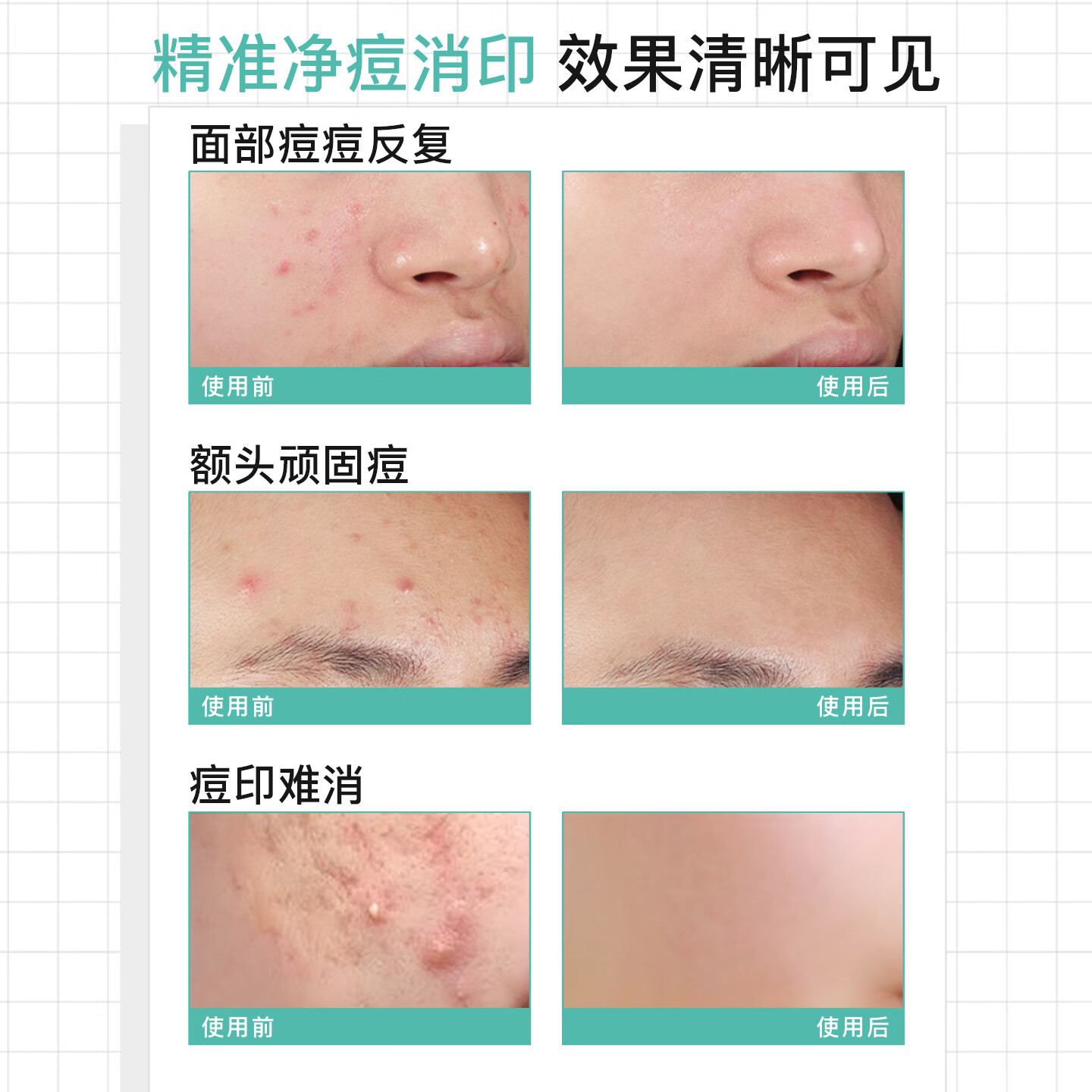 NOVEXPERT诺士博点痘精华笔 果酸祛痘淡印 舒缓闭口粉刺痤疮祛痘棒 【8H速瘪痘】祛痘笔7ml