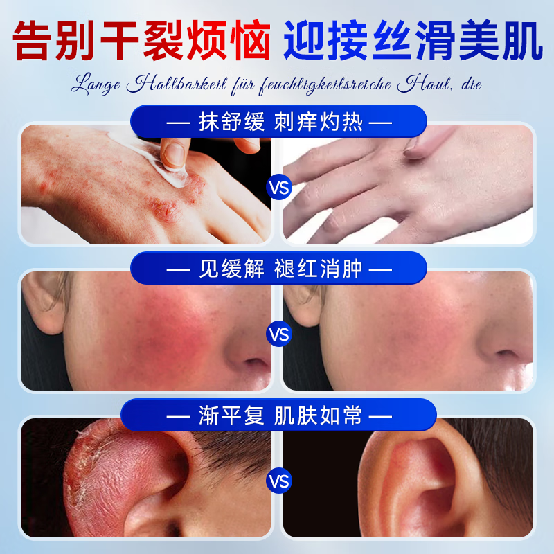 VADERNVA德国冻疮膏耳朵手足成人脸止痒冻伤膏消痛儿童男女士冻伤膏特效 三盒装【中重度】冻疮感染红肿出血