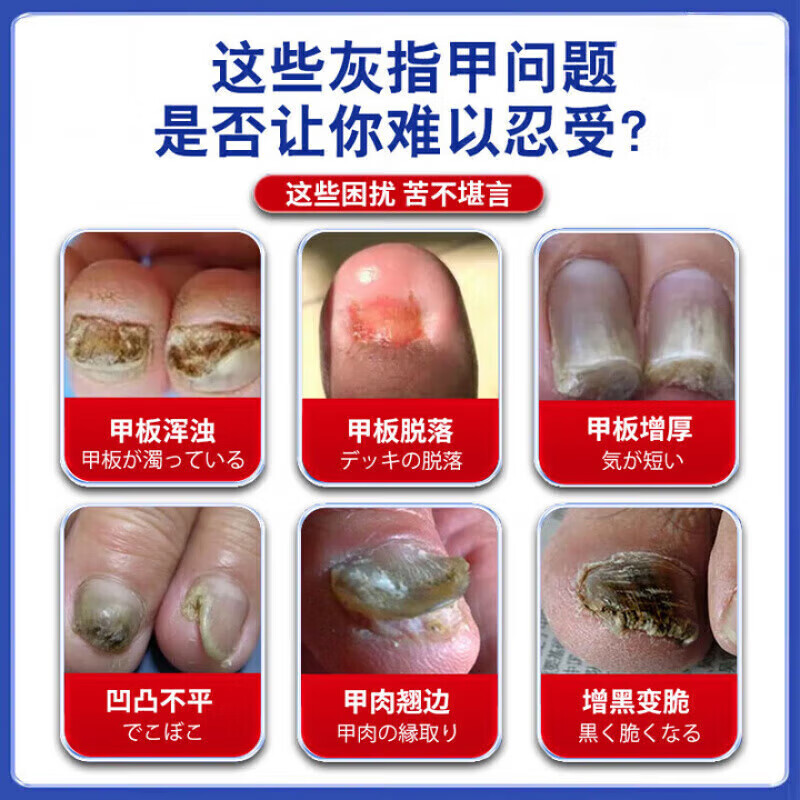 御灵花灰指甲发黄增厚软甲坏甲空甲萎缩甲变色男女适用专用护理膏 1支装【体验发正装】 【官方直售 京质保障】 御灵花灰指甲发黄增厚软甲坏甲空甲萎缩甲变色男女适用专用护理膏 1支装【体验发正装】 【官方直售 京质保障】
