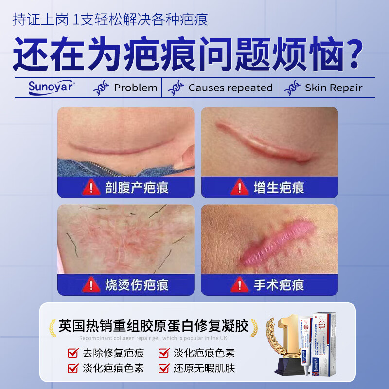 Sunoyar祛疤膏儿童专用去黑色素沉淀药膏手术缝针疤痕修复乳膏烫伤烧伤软 5支【适用于大面积增生疤痕】买3送2