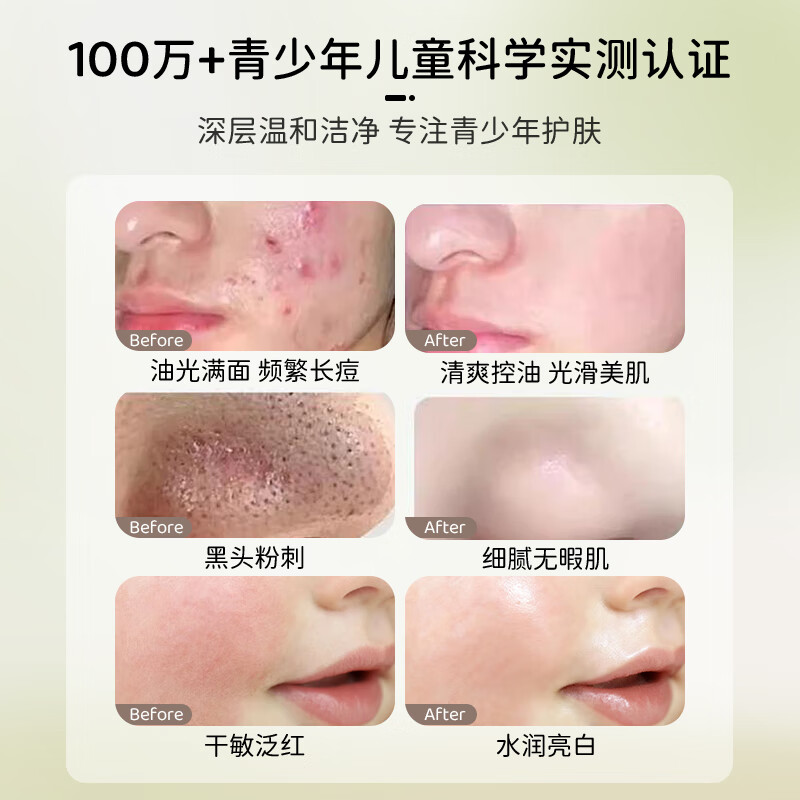 童贝比胖东儿童洗面奶6-12岁控油祛痘黑头來青少年学生12-18岁洁面乳液 【祛痘控油】洗面奶*1 【央妈力荐】推荐青少年控油祛痘护肤TOP榜