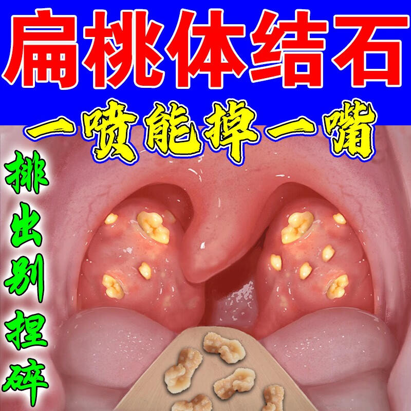 九督堂 扁桃体肥大结石张口吞咽困难喉咙肿痛异物感去除工具喷雾 【单