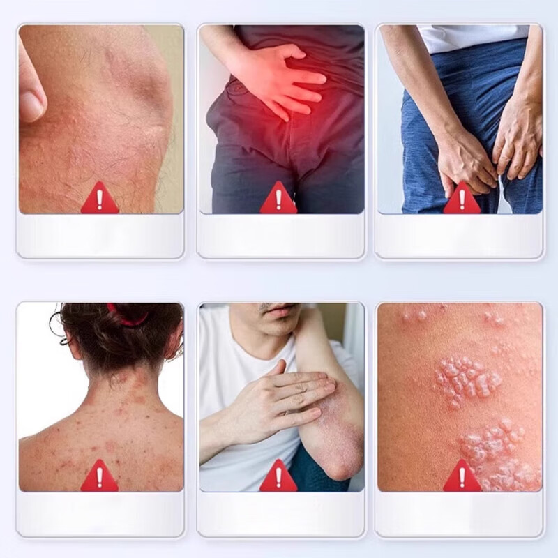 温医师带状疱疹后遗症神经痛外用喷中药蛇缠腰蛇盘疮 30ml 带状疱疹喷剂:5瓶/