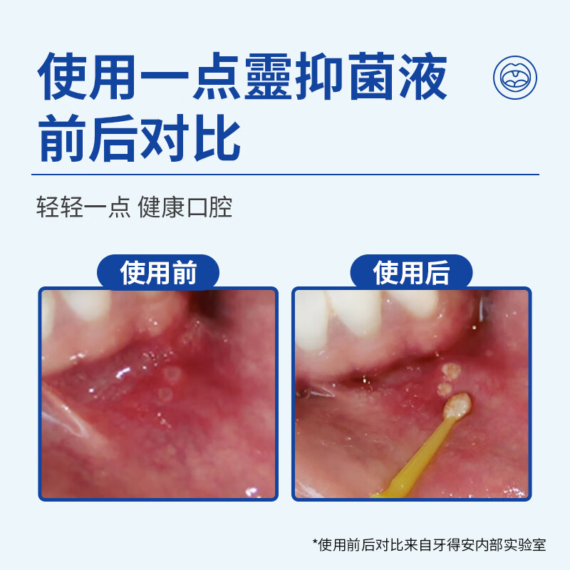 牙得安一点灵正品上火口腔不适口腔黏膜凉茶铺起泡送涂抹棒100支+牙粉 1.5m防伪一点灵+涂抹棒+牙粉五小包