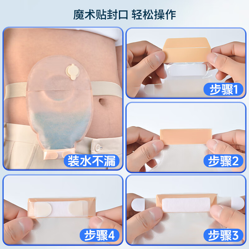护士同学一件式微凸面底盘造口袋一次性凸面可排气大便袋肛肠防凹陷造瘘袋 1秒排气款【5片】双层微凸底盘+送棉签