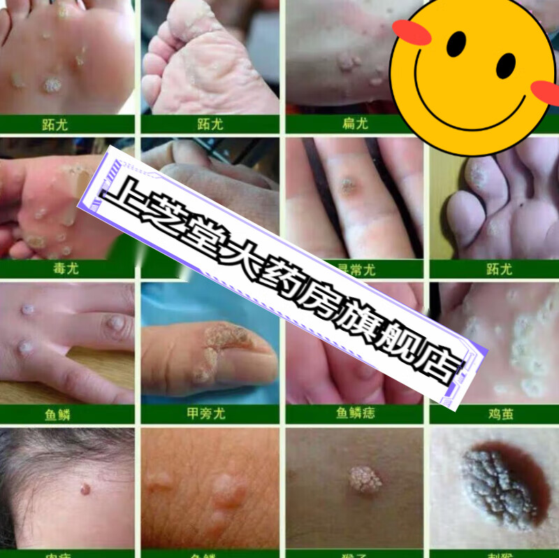 澳德力康     瘊优偏方膏皮肤膏上长小肉粒疙瘩腋下猴子疣膏 一瓶