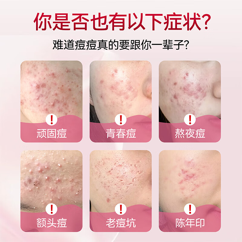 御信堂宁红牌一杯清颗粒祛痤疮内调缓解痘痘改善肠胃美容养颜 8盒【巩固装】内调祛痘改善便秘 5袋*8盒