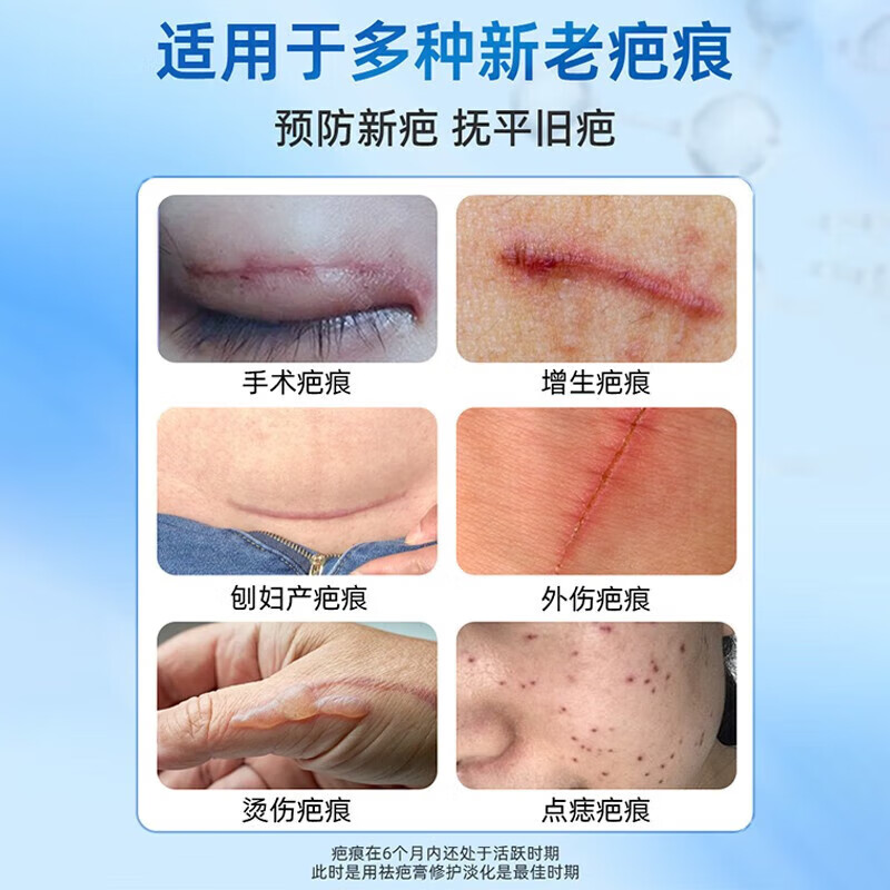疤克祛疤膏芭儿童专用手术缝针疤痕修复除疤医用硅酮疤痕凝胶新旧疤 1盒【体验装】