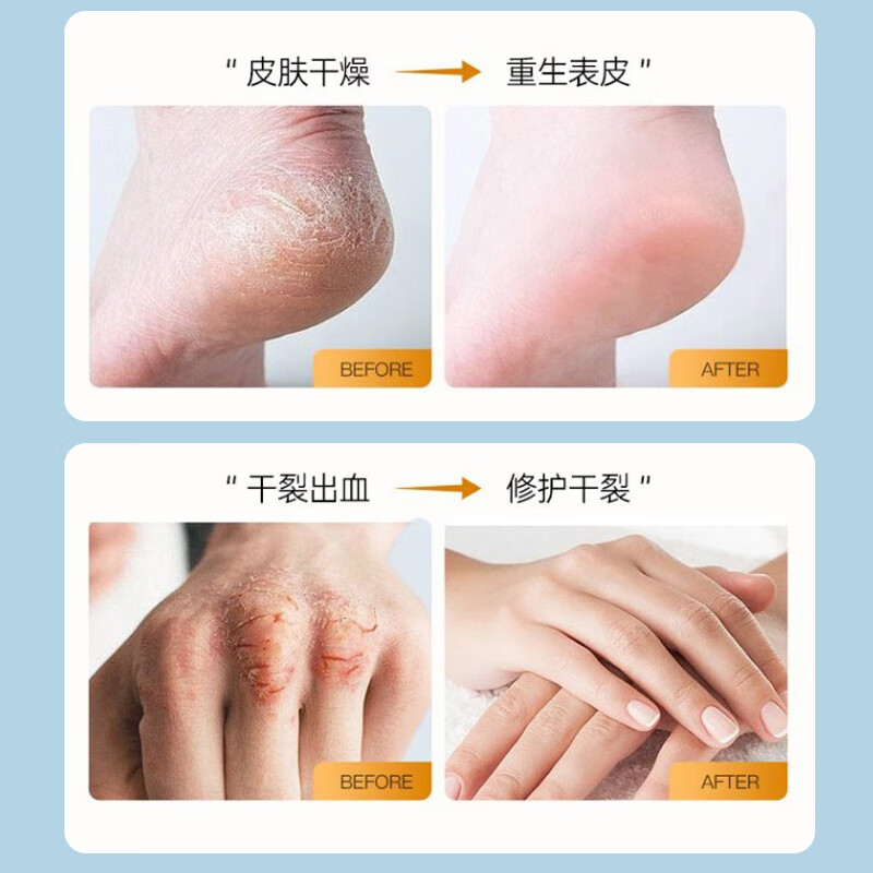 SKT足部皴裂露走珠皴裂膏修护脚后跟干裂足霜干燥滋润保湿手足霜 SKT足部皴裂凝露50g