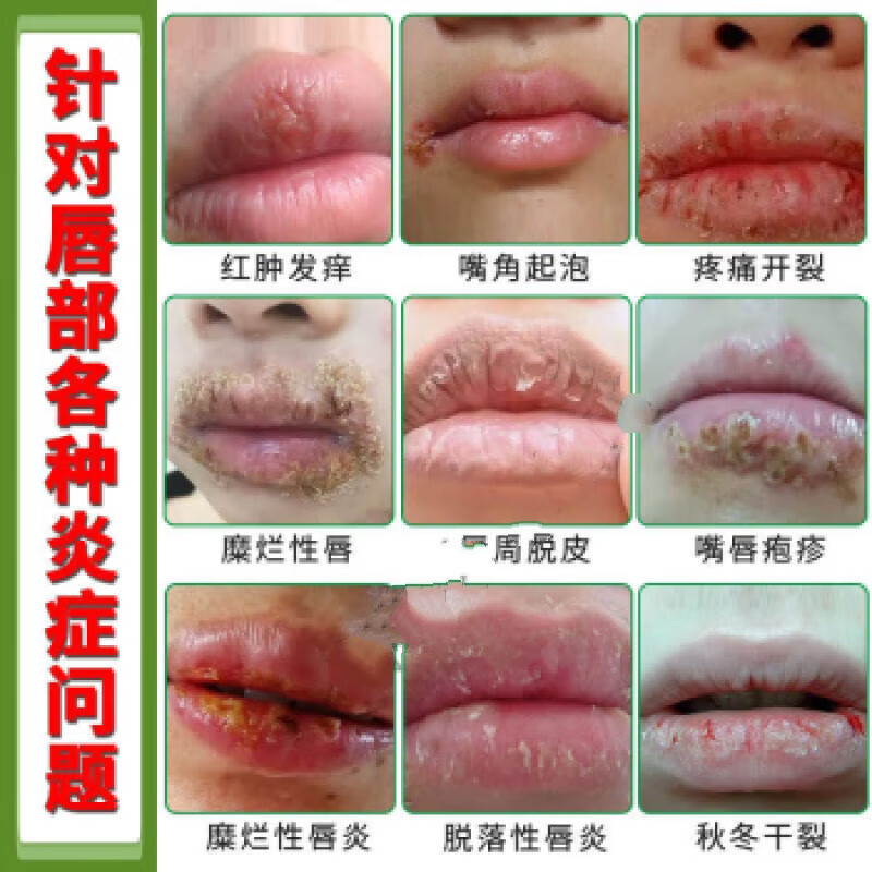 澳德力康嘴角溃烂软膏口角炎修复膏烂嘴角秋冬干裂开裂起泡溃烂疼痛红肿发 买3+2【五盒巩固装】，