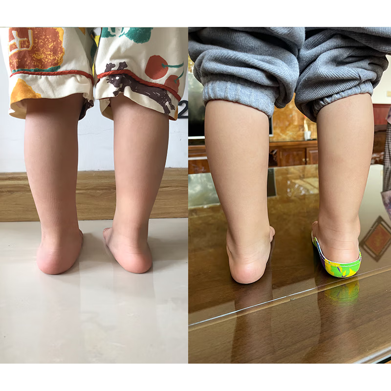 扁平足鞋垫儿童定制高足弓支撑垫平脚板足外内翻纠器 18码垫长11.