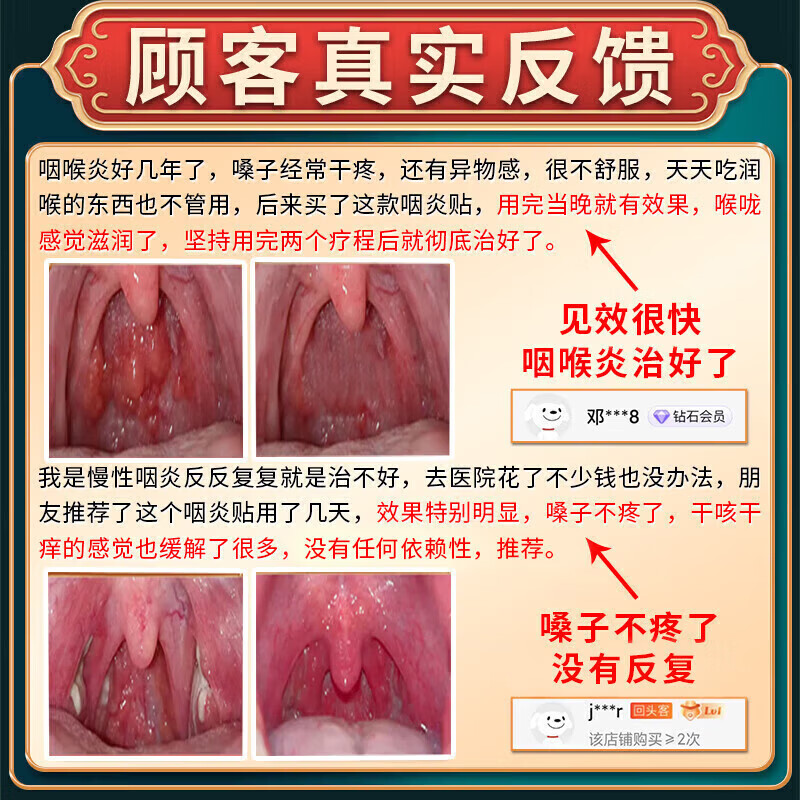 岩井昃弘进口咽喉炎专用膏药贴重度急慢性咽炎喉咙痒干咳呕痒异物感咽扁 特效一盒【日本原装】多买多送 咽喉炎的喉咙痒异物感有粘痰