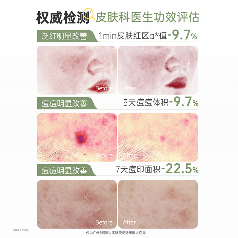 袋鼠妈妈（Kangaroo Mommy）袋鼠妈妈青少年护肤控油净痘舒缓淡化痘印青春期学生祛痘修护棉片 【净痘淡印】祛痘修护棉片100片