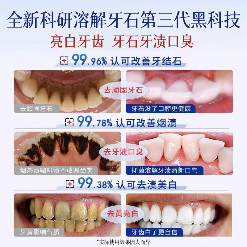 坂枝野寻漱口水便携牙结石口臭去黄牙石牙垢牙周膏炎牙渍速傚溶解清新口气 买二送一【周期装】3瓶