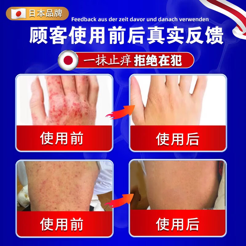 北京协和医学院湿疹药膏十大牌子皮肤瘙痒皮炎湿疹真菌感染止痒苗药日本原装进口 3盒【专攻各种湿疹包痊愈柏可芬 诺瑞达湿疹冬季皮肤瘙痒止痒