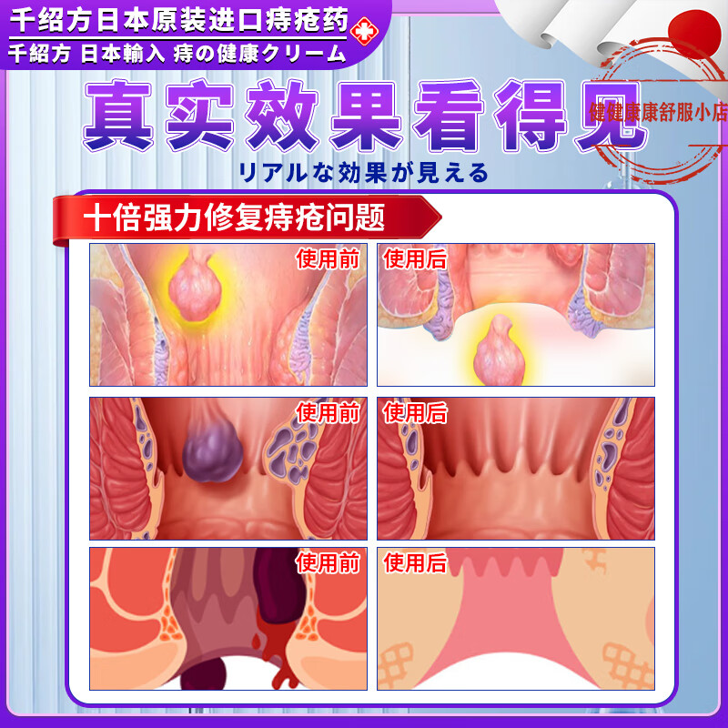 然舒平痔疮膏消肉球便血肛裂混合内外痔肛门瘙痒消痔疮凝胶正品 二支【见效装】 【正品直售 京质保障】