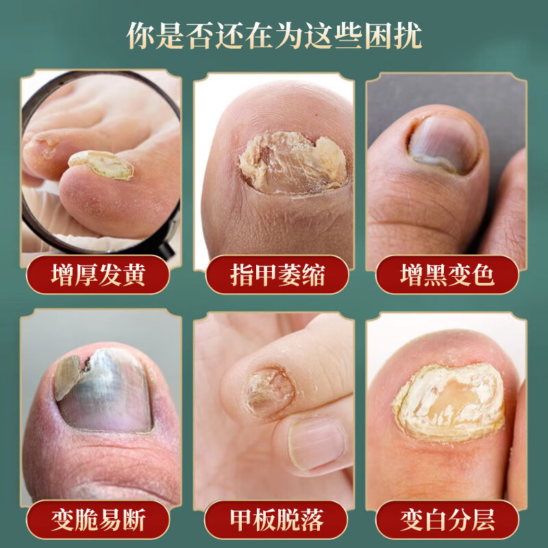 凤仙花官方旗舰店凤仙花抑菌液灰指甲凝胶套装温和吸收男女通用 30ml*3（多买优惠）